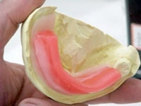 ロウ堤の作成を行います。技工士がろう提を作成しているところです。ベースになる部分にろうを貼り付けています。