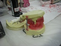 ロウ堤による噛み合わせ確認を行います。ろう堤を患者さんのお口に装着し、唇との調和などを見ながら咬み合わせの調整をしっかりと行います。